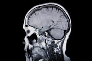 brain-injury-MRI